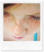 Веснушки на лице