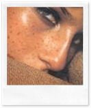 Загар и веснушки