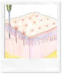 Мезотерапия для омоложения