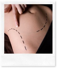 Подтяжка живота