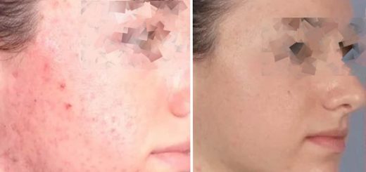 химический пилинг от прыщей