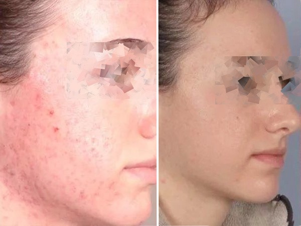 химический пилинг от прыщей