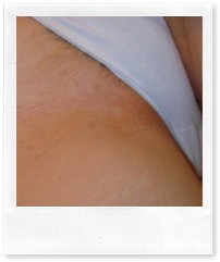 Эпиляция бикини