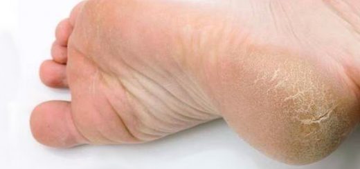 Трещины на стопах: как забыть о том, что мешает быть совершенством