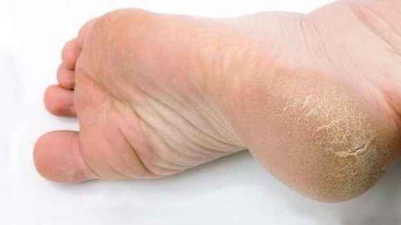 Трещины на стопах: как забыть о том, что мешает быть совершенством