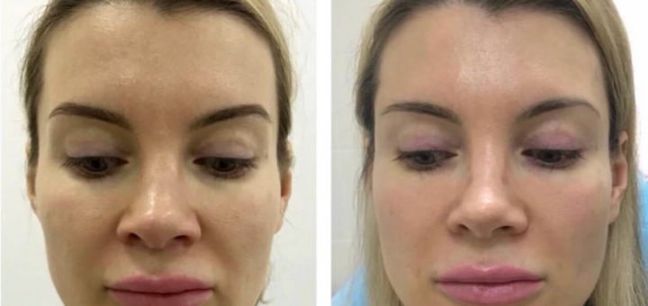 липофилинг лица