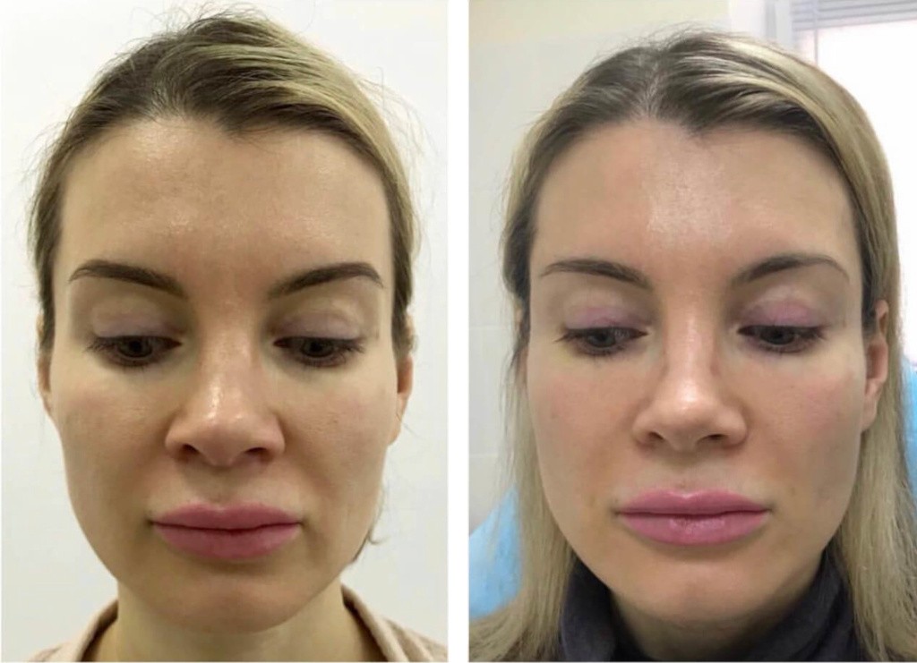 липофилинг лица