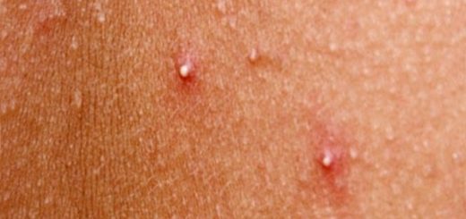 Прыщи на теле