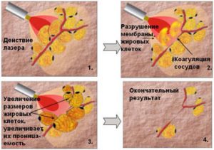 воздействие лазерной липосакции