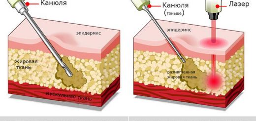 Сравнение лазерной и обычной липосакций