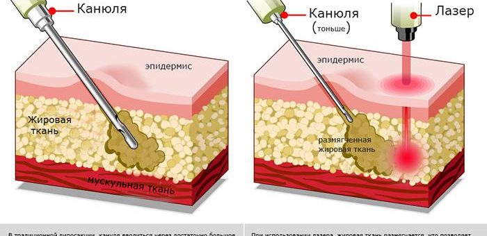 Сравнение лазерной и обычной липосакций