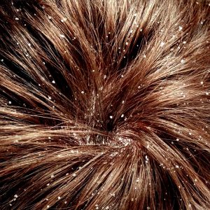 перхоть на голове