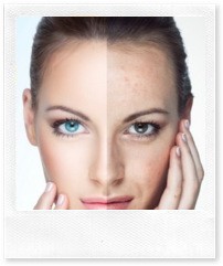 Плазмолифтинг: как стимулировать естественное восстановление кожи