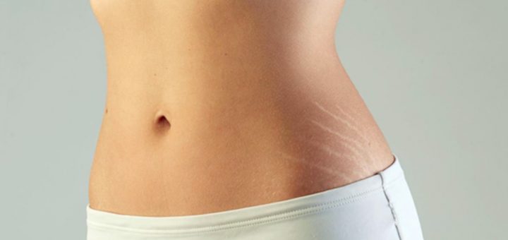 растяжки или стрии на бедре