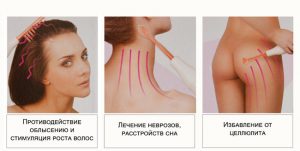 применение дарсонваля в косметологии