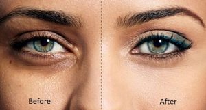 черные круги под глазами