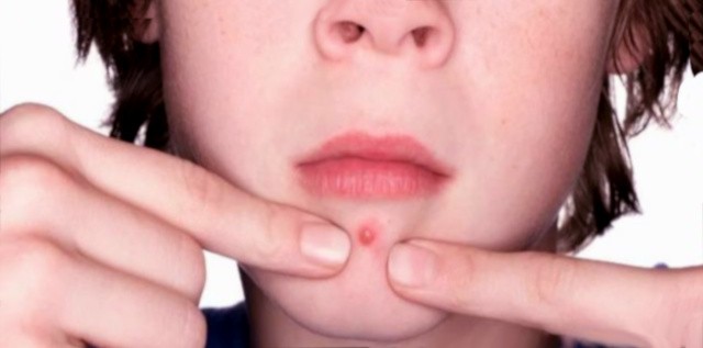 Прыщи у подростка