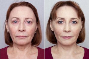 чек-лифтинг до и после