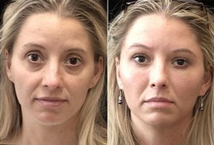 Чик лифтинг