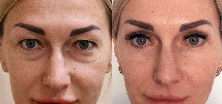 Блефаропластика до и после