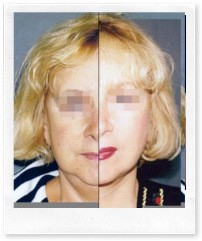 Ритидэктомия. До и после.