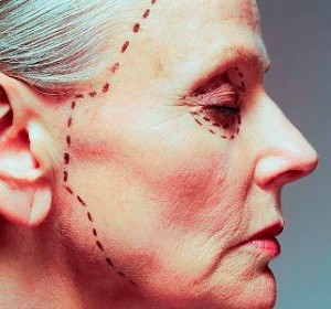 Ритидэктомия. Круговая подтяжка.