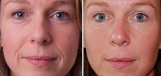 носогубные складки до и после пластики