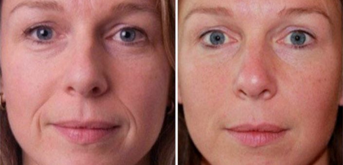 носогубные складки до и после пластики