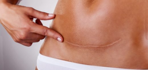 келоидный рубец