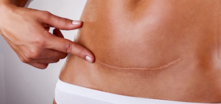 келоидный рубец