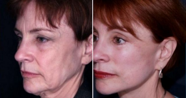 Ритидэктомия до и после