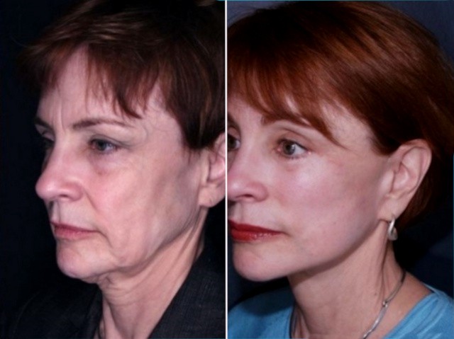 Ритидэктомия до и после