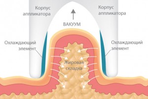 Криолиполиз