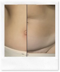 Абдоминопластика