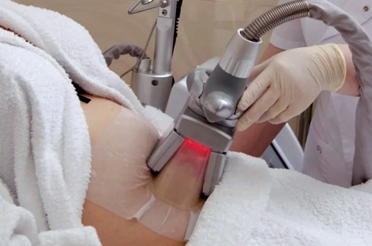 криолиполиз живота