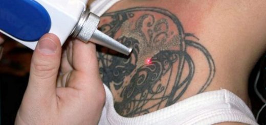 удаление татуировок лазером