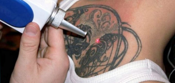 удаление татуировок лазером