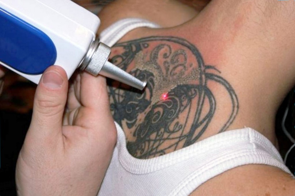 удаление татуировок лазером