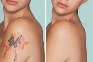 удаление татуировок до и после