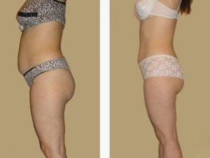 Мезодиссолюция  до и после