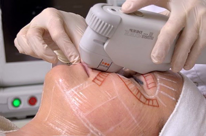 ультразвуковой лифтинг