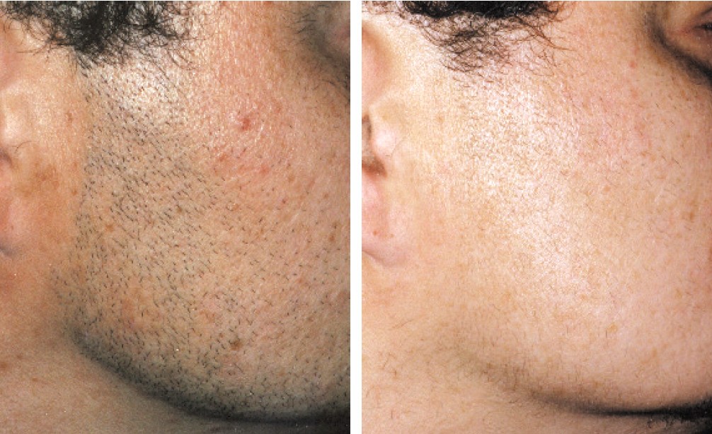 Лазерная эпиляция