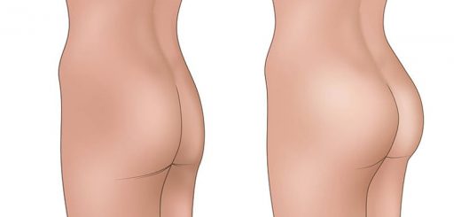 глютеопластика до и после