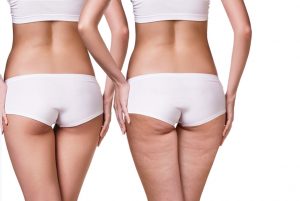 с целлюлитом и без