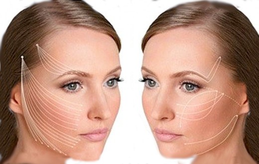 Нитевая подтяжка лица