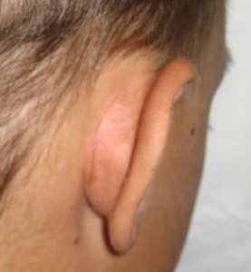  коррекции ушных раковин