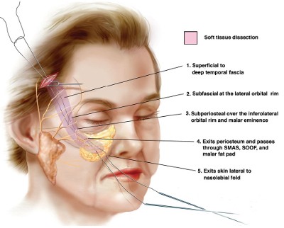 endoskopicheskaya_podtyazhka