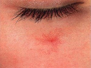 сосудистые звездочки под глазами