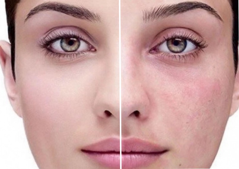 сосудистые звездочки