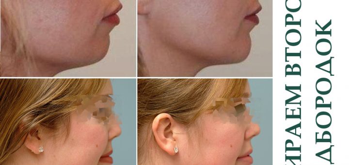 второй подбородок